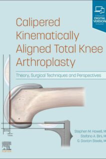 Calipered Kinematically aligned Total Knee Arthroplasty, 1st Edition